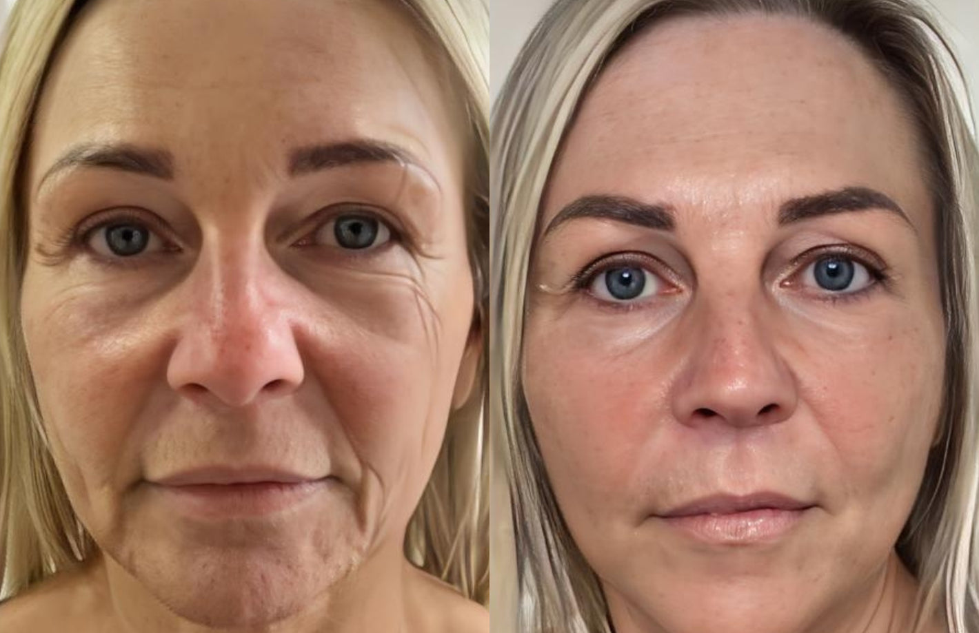 Anti-ageing results on mature skin showing softened nasolabial folds and wrinkles using red light therapy device.