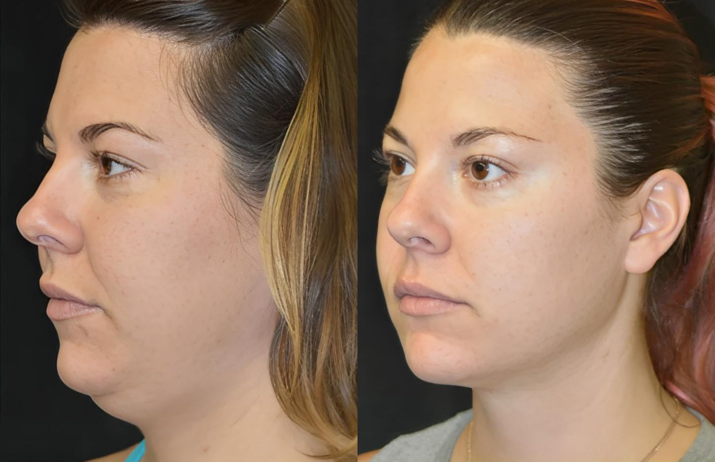 Side profile transformation showing defined jawline and double chin removal using face and neck lifting tool.