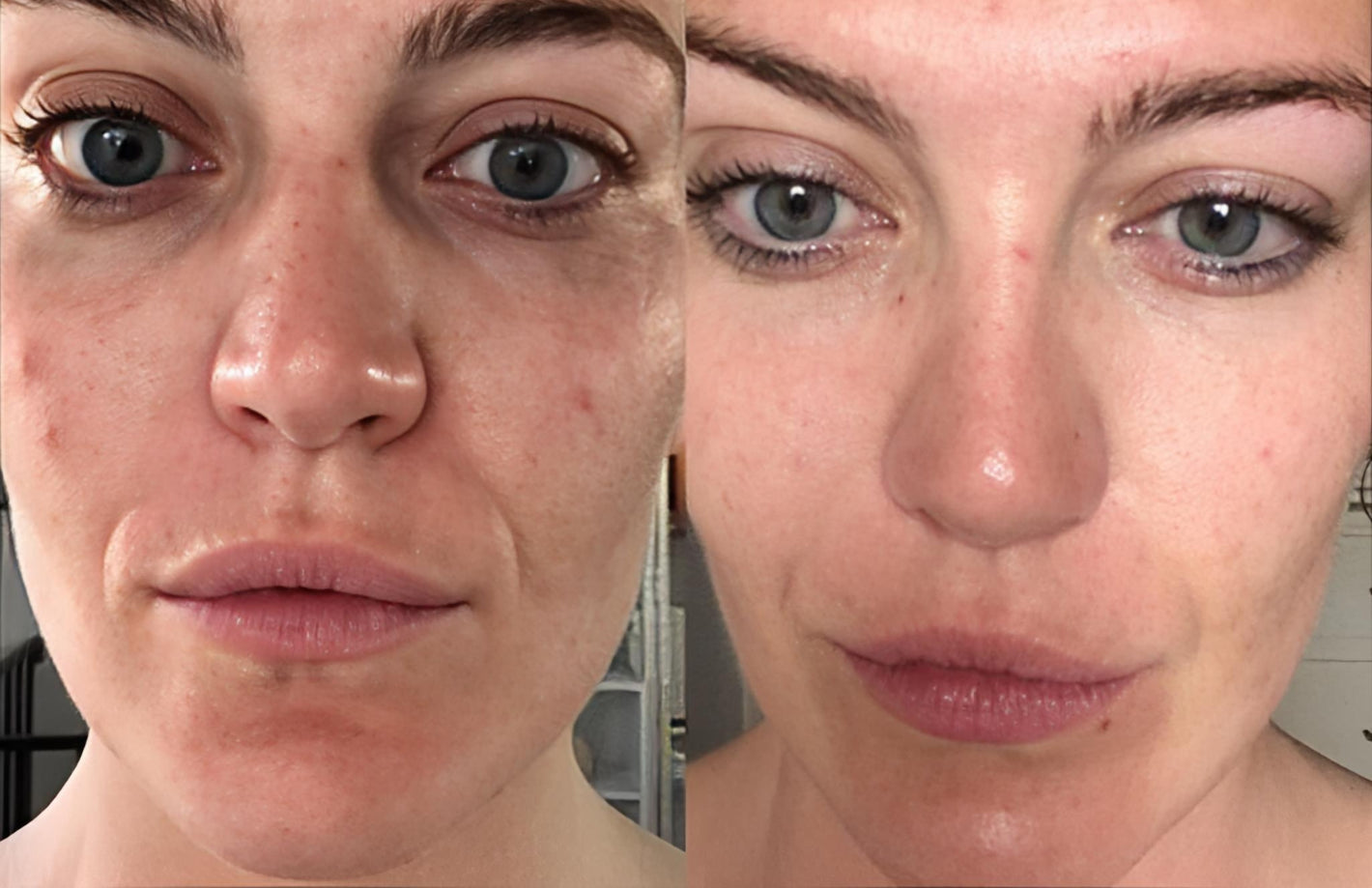 Customer results showing smoother skin texture and reduced redness using LED light therapy facial massager.