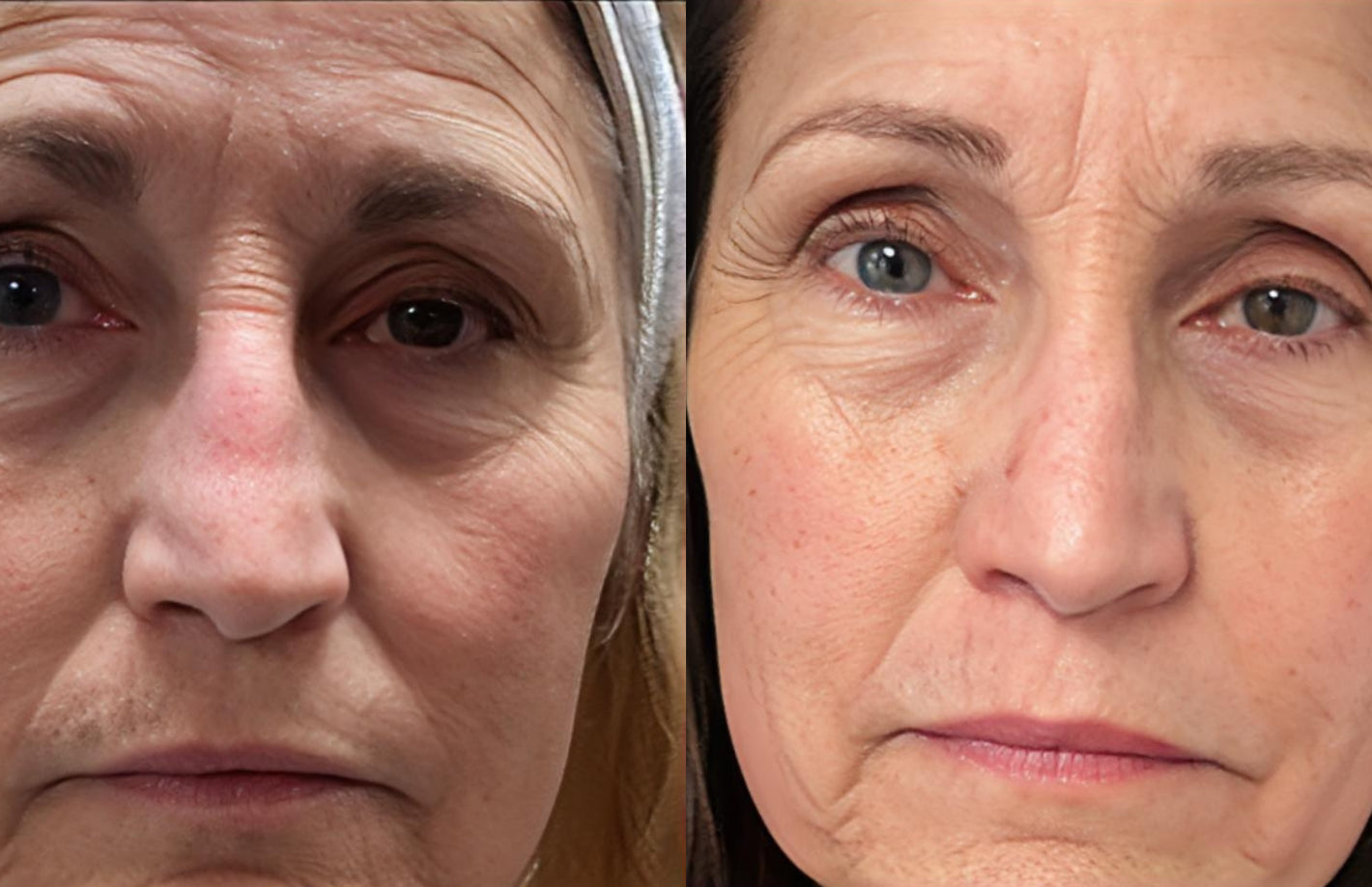 Before and after photos demonstrating reduction of deep forehead wrinkles and frown lines using LED face massager.