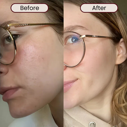 Real before and after results of using LED light face massager showing reduced redness, acne improvement, and tighter skin texture.