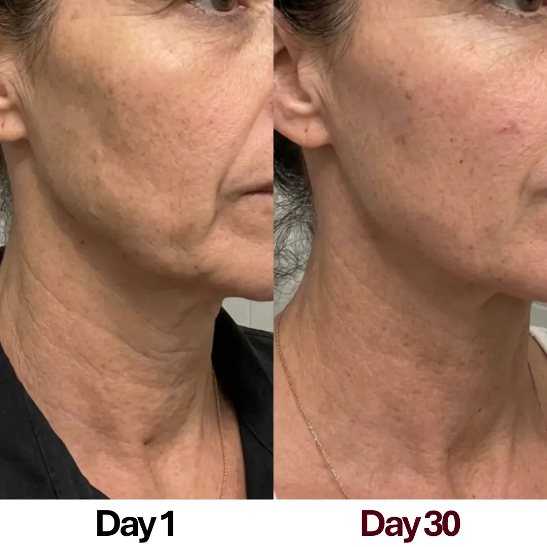 Dramatic 30-day before and after transformation showing the reduction of turkey neck and deep neck wrinkles using the Skin Revive contouring device.