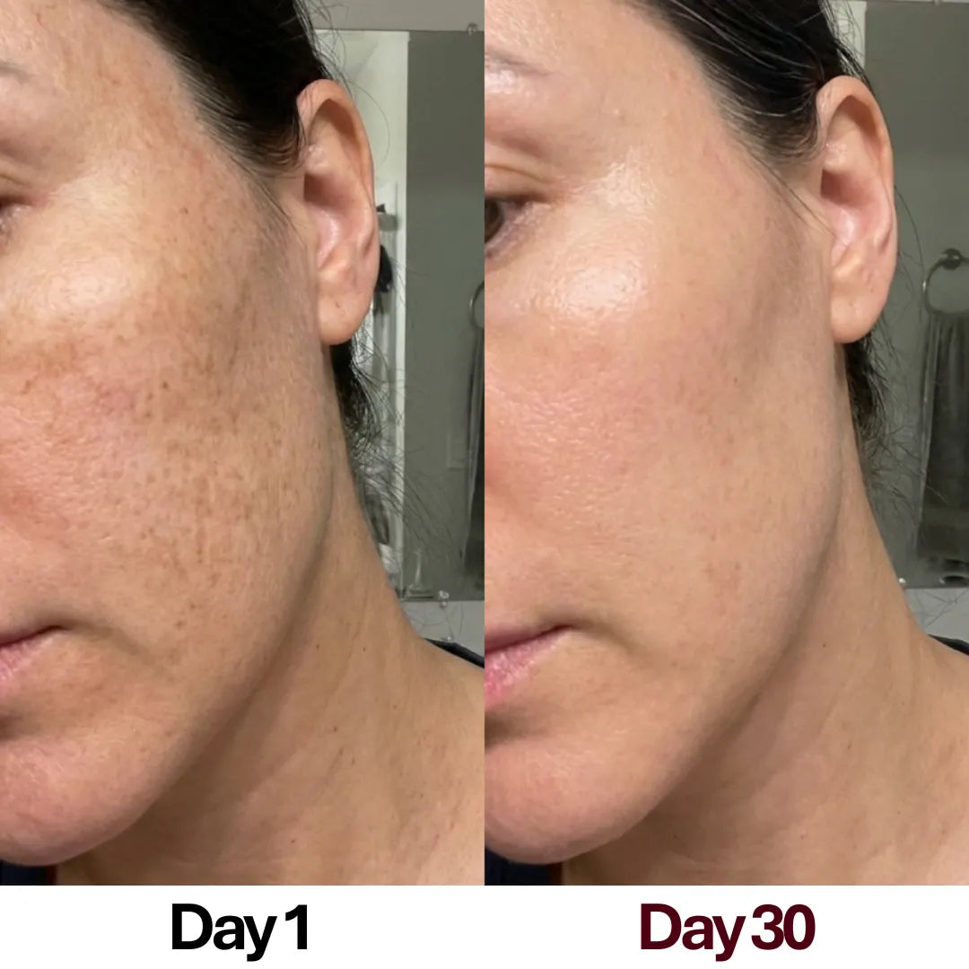 30-day before and after results of a woman successfully firming sagging jowls and tightening her jawline using the Skin Revive LED massager.