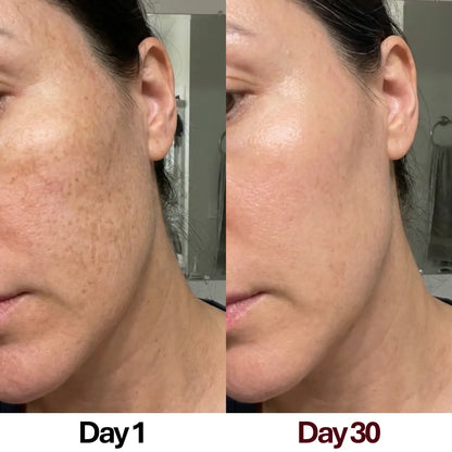 30-day before and after results of a woman successfully firming sagging jowls and tightening her jawline using the Skin Revive LED massager.