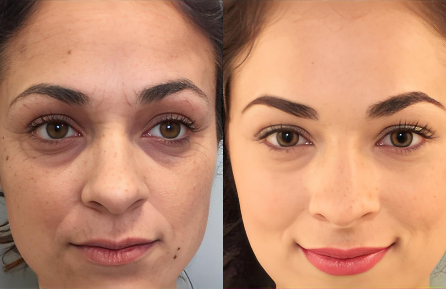 Visible reduction in dark circles and under-eye bags achieved with Skin Revive sonic vibration eye and face massager.